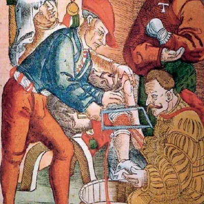 Xilografia che ritrae un'amputazione medievale delle gambe. Da Feldbuch der Wundartzney pubblicata a Strasburgo nel 1517 da Hans von Gersdorff